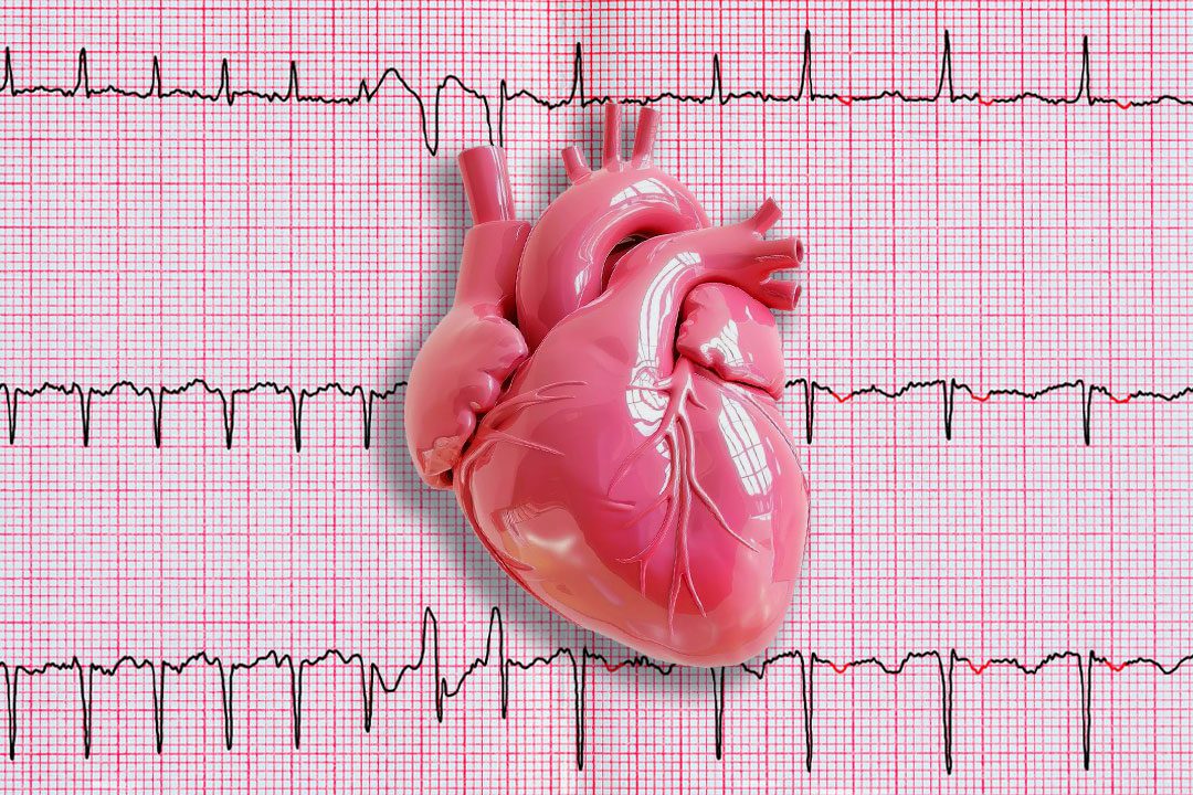 Extrassístoles (ectopias): o que são, por que aparecem e como tratar
